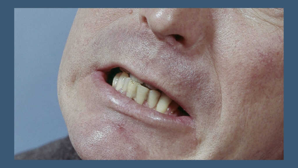Teeth Grinding